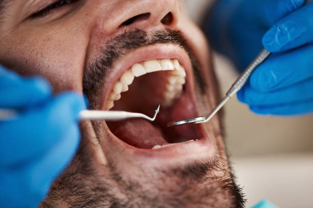 Best Broken or Chipped Tooth Repair in Imperial, MO